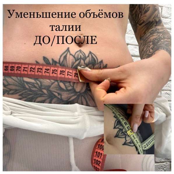 LPG массаж в Москве фото 3