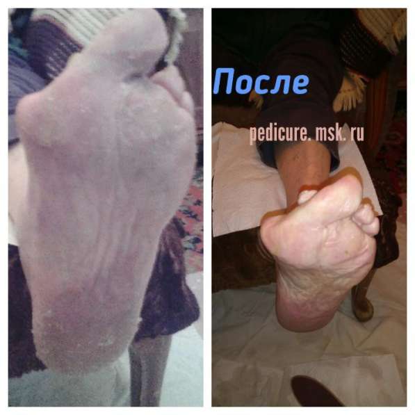 Педикюр для Пожилых Людей и Людей с проблемными ногами в Москве фото 5